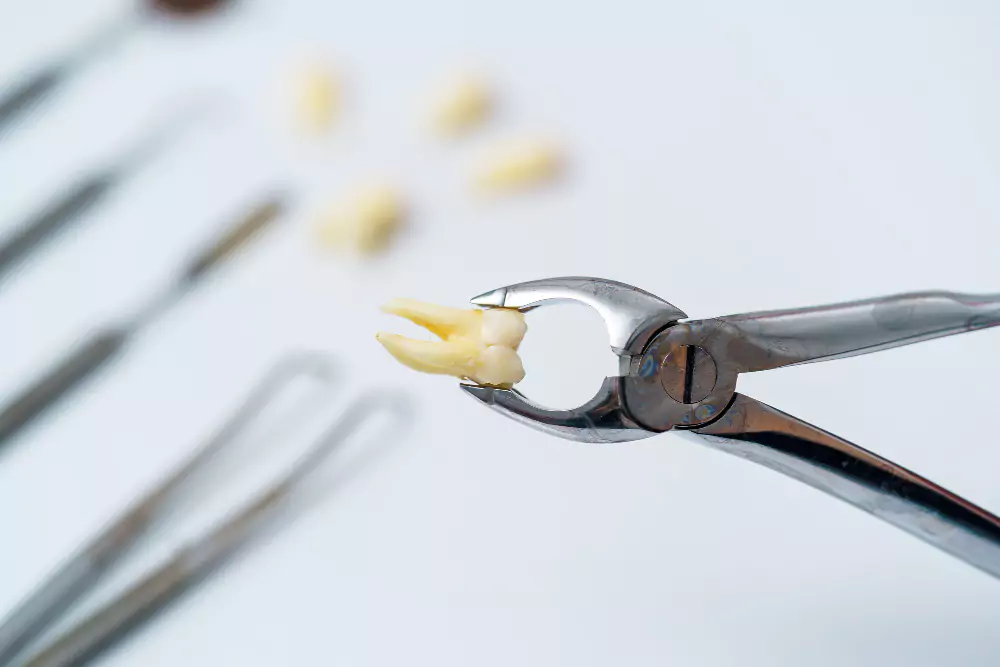 Tooth Extraction